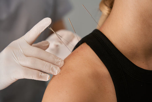 Pinpoint Better Sleep: Snooze Naturally with Acupuncture